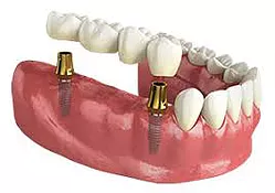Fixed Single/Multiple Teeth Replacement by Crown and Bridge
